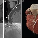 PCCT boosts diagnostic accuracy for coronary stent assessment