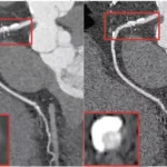 Both standard and ultrahigh resolution modes effective for PCCT CCTA