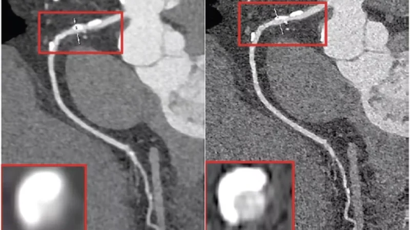 Both standard and ultrahigh resolution modes effective for PCCT CCTA