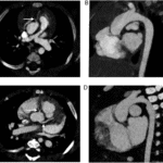 Photon-Counting CT Achieves Over 40% Radiation Dose Reduction in Pediatric Congenital Heart Disease Imaging, Study Finds