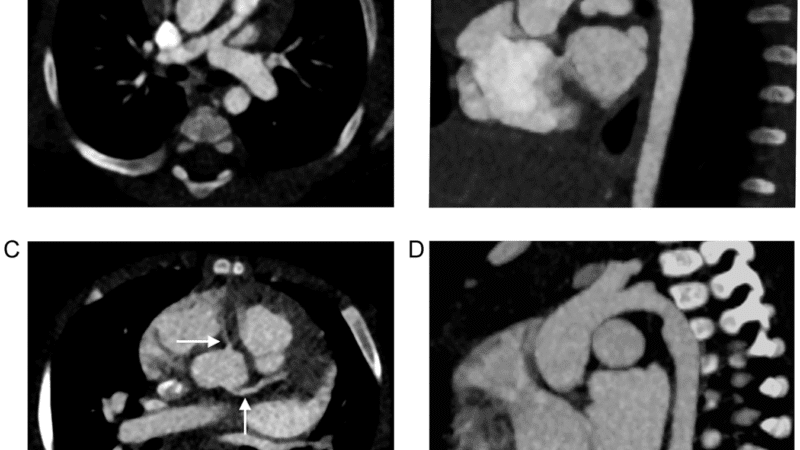 Photon-Counting CT Achieves Over 40% Radiation Dose Reduction in Pediatric Congenital Heart Disease Imaging, Study Finds