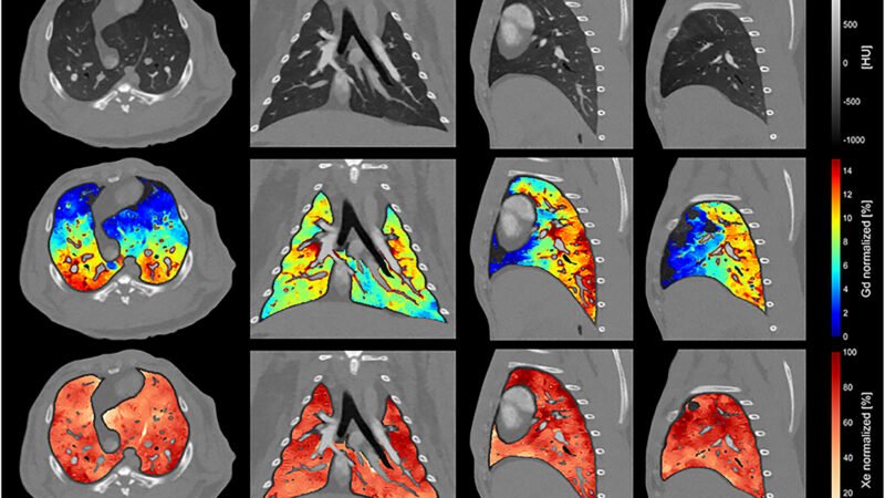 K-Edge Imaging: How PCCT Told Xenon From Gadolinium