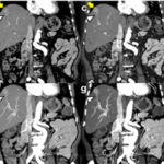 Photon-Counting CT in Abdominal Imaging – a narrative review