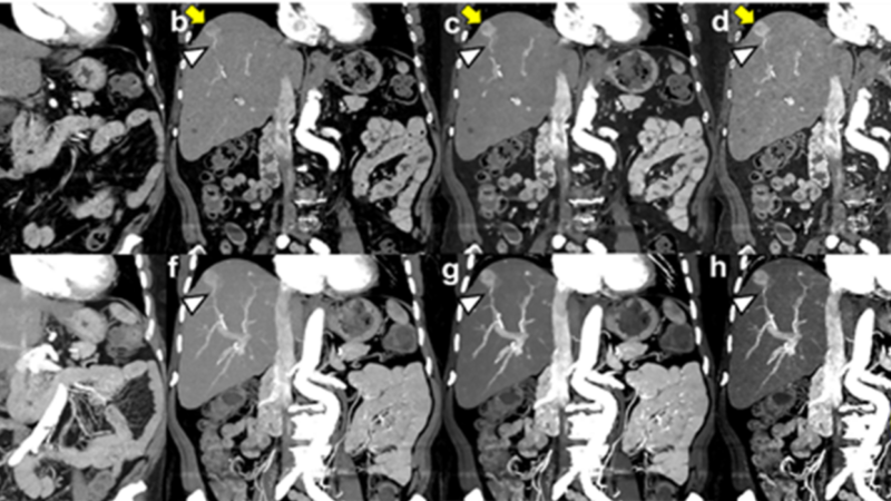 Photon-Counting CT in Abdominal Imaging – a narrative review