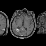 Photon-Counting CT Myelography and CSF-Venous Fistulas