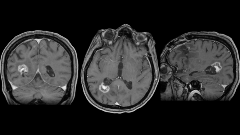 Photon-Counting CT Myelography and CSF-Venous Fistulas