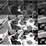 Photon-Counting CT Reveals New Myeloma Bone Patterns