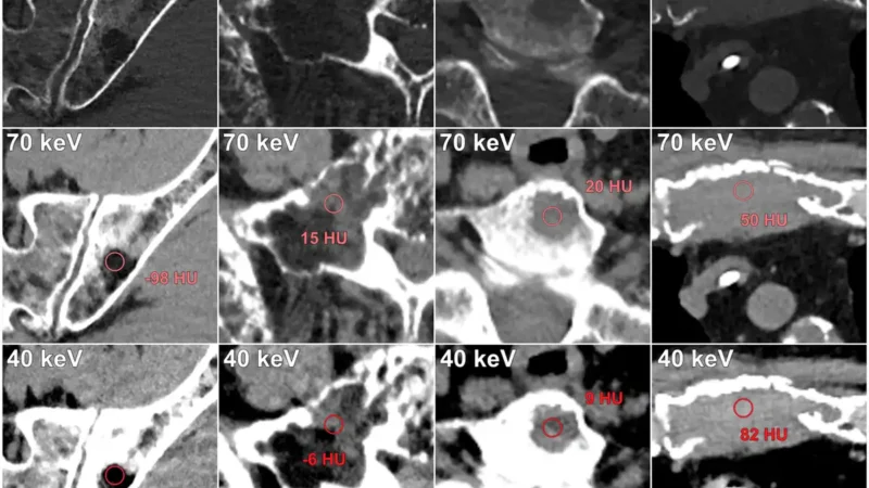 Photon-Counting CT Reveals New Myeloma Bone Patterns