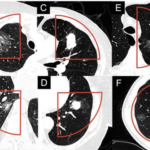 Photon-Counting CT and Lung Cancer Screening: Phantom Study
