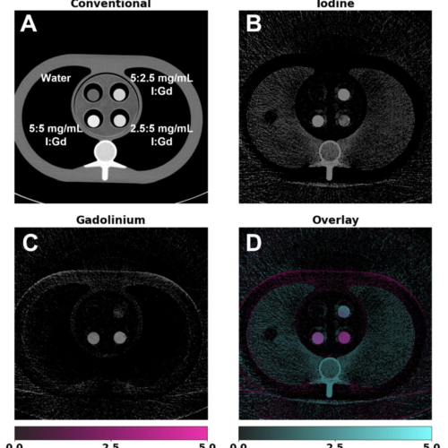 Material-specific images of gadolinium and iodine using K-edge imaging. Inserts containing varying concentrations of I and Gd were placed within a thoracic phantom and scanned. Conventional images (A) display a standard grayscale CT attenuation image (WL/WW: 200/600 HU), illustrating the inability to separate the two contrast agents. Iodine maps (B) (WL/WW: 2.5/5 mg/mL) show successful localization of iodine within inserts, with gadolinium maps (C) (WL/WW: 2.5/5 mg/mL) also achieving successful separation of gadolinium and iodine within the same volume. An overlay image (D) highlights the spatial distribution of both contrast agents, enabling enhanced visualization of co-localized and distinct regions of each contrast agent.