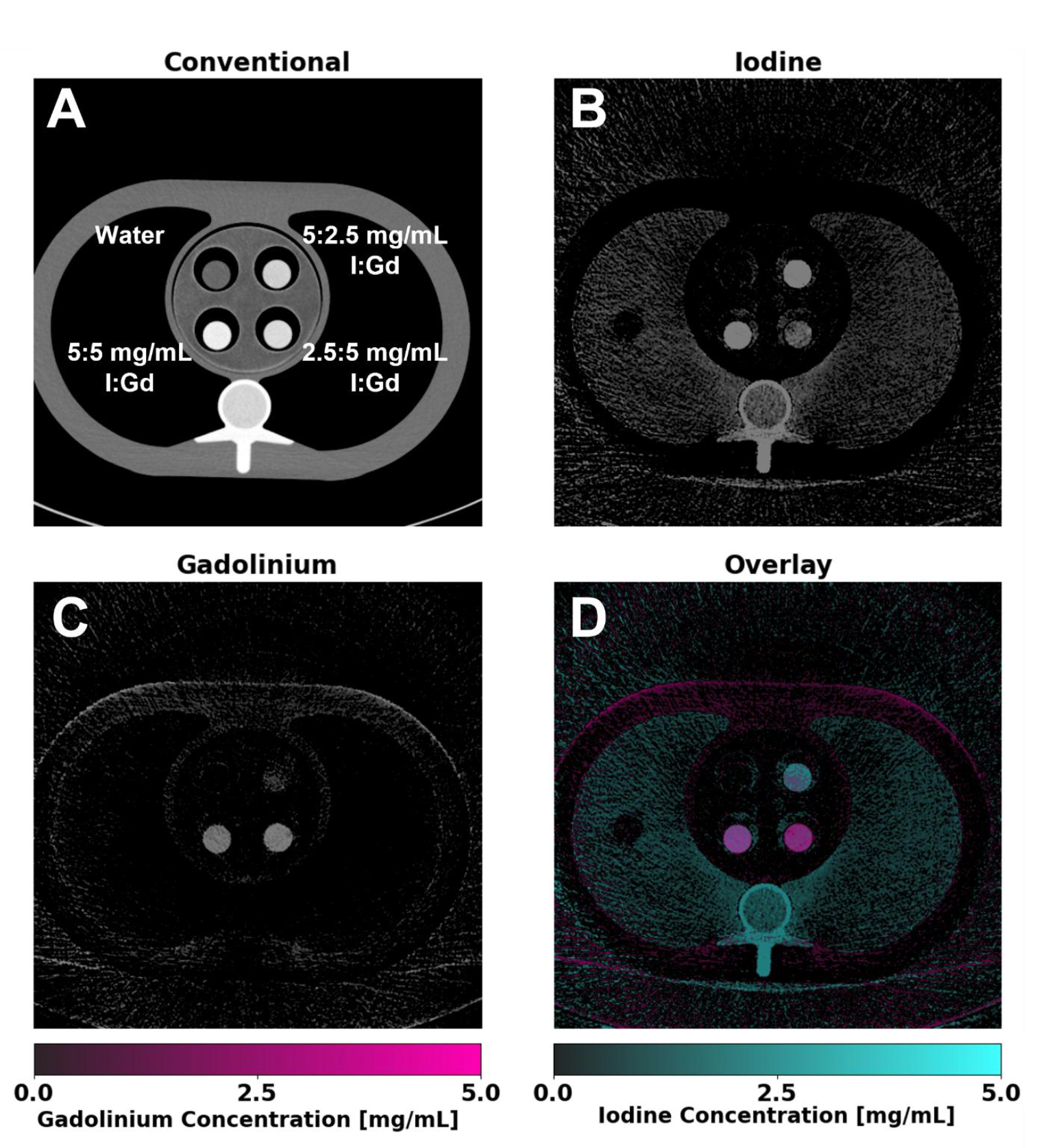 Material-specific images of gadolinium and iodine using K-edge imaging. Inserts containing varying concentrations of I and Gd were placed within a thoracic phantom and scanned. Conventional images (A) display a standard grayscale CT attenuation image (WL/WW: 200/600 HU), illustrating the inability to separate the two contrast agents. Iodine maps (B) (WL/WW: 2.5/5 mg/mL) show successful localization of iodine within inserts, with gadolinium maps (C) (WL/WW: 2.5/5 mg/mL) also achieving successful separation of gadolinium and iodine within the same volume. An overlay image (D) highlights the spatial distribution of both contrast agents, enabling enhanced visualization of co-localized and distinct regions of each contrast agent.