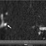 Photon-Counting CT in Neuroradiology: The Evidence So Far