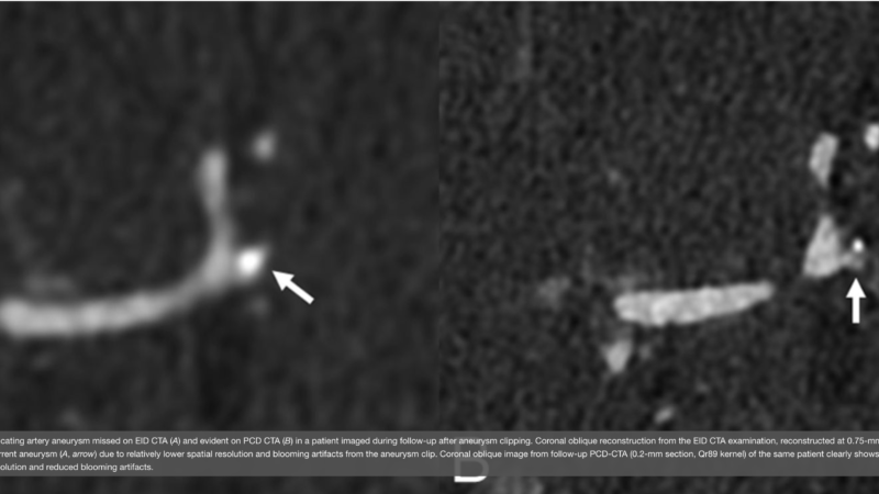 Photon-Counting CT in Neuroradiology: The Evidence So Far