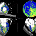 PCCT and Cardiac ECV: Evidence and Implementation