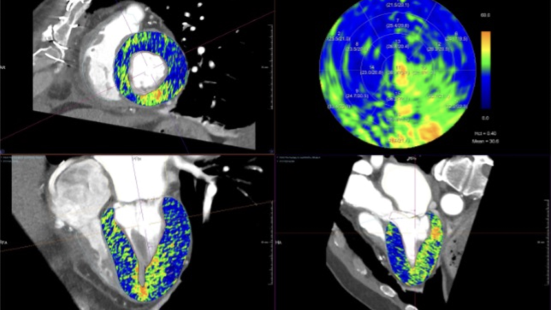 PCCT and Cardiac ECV: Evidence and Implementation
