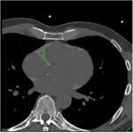 PCCT Radiomics of Epicardial Fat