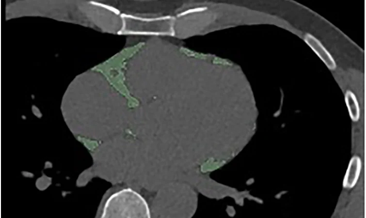 PCCT Radiomics of Epicardial Fat