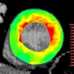 Photon-Counting CT Late Iodine Enhancement: What We Know