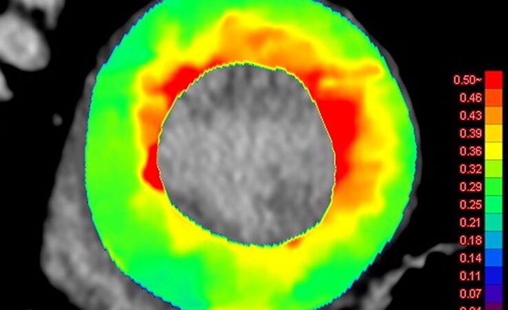 Photon-Counting CT Late Iodine Enhancement: What We Know