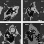 Photon-Counting CT for Temporal Bone: What Evidence Shows