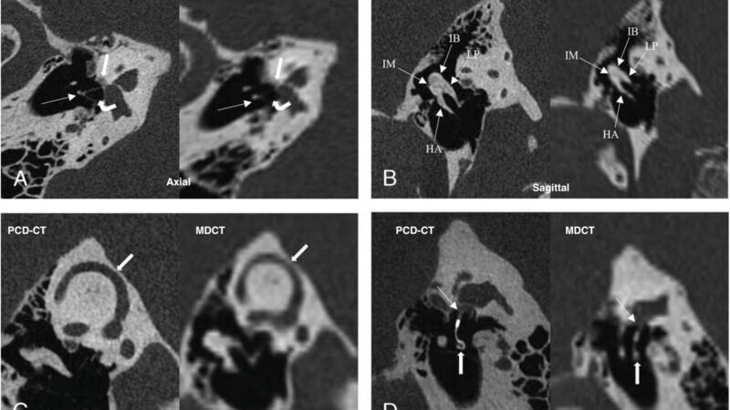 Photon-Counting CT for Temporal Bone: What Evidence Shows